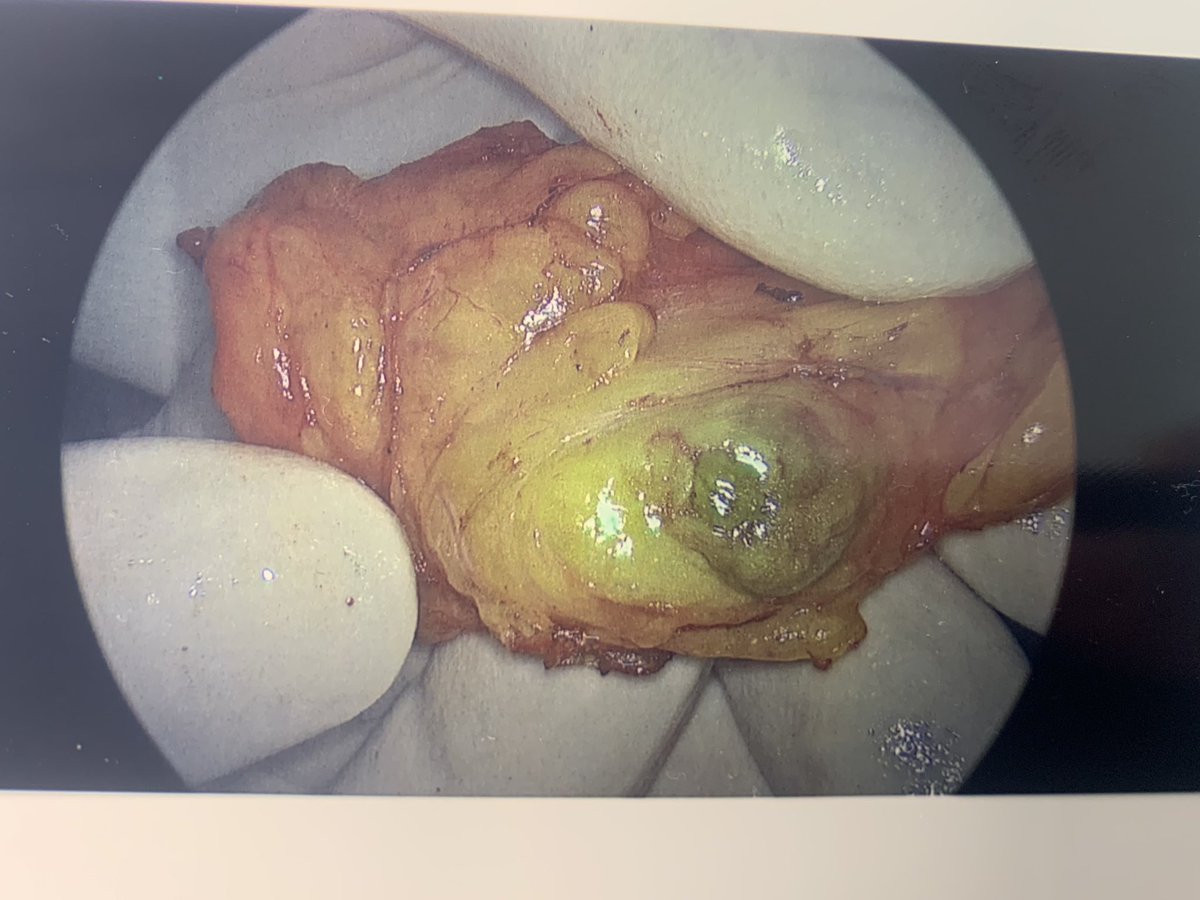 VATS parathyroidectomy for parathyroid adenoma on aortic arch <a href="/OUHospitals/">OUH</a>  today. Many thanks to <a href="/NBCLBV/">NBCL</a> intra op PTH and @Sallyshiels1  for helping make this a successful case. ICG auto fluorescence in post op specimen