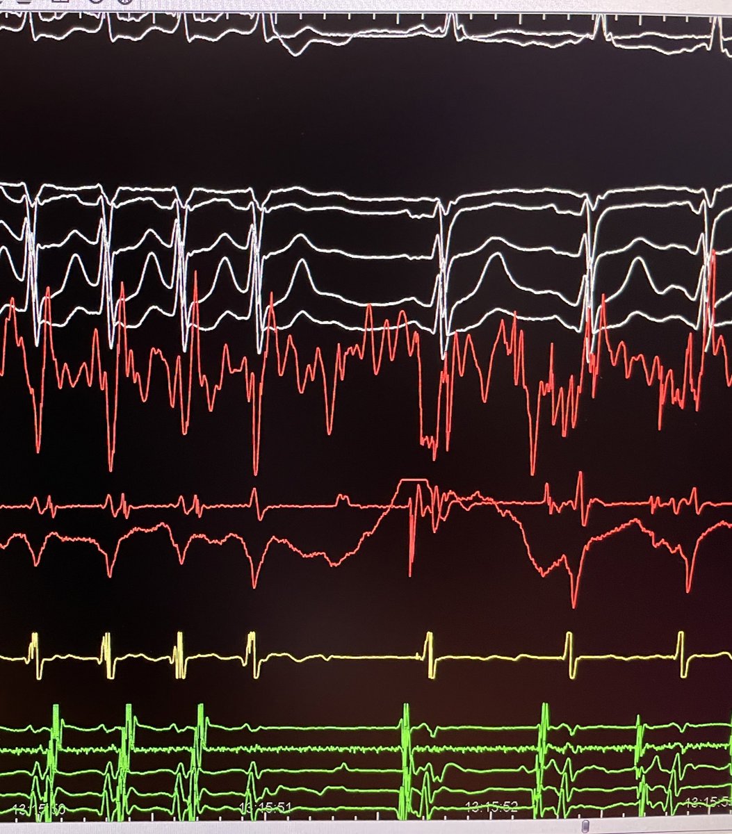 ๐ป๐๐๐๐ ๐ถ ๐ผ๐๐๐๐๐๐ (@laila_g) on Twitter photo WPW Sx . Open window CARTO mapping. Pretty illustrative electrograms during RDF. #cardiotwitter #epeeps @JosMart42952309 <a href="/CarlosMinguito/">Carlos Minguito</a> WPW Sx . Open window CARTO mapping. Pretty illustrative electrograms during RDF. #cardiotwitter #epeeps @JosMart42952309 <a href="/CarlosMinguito/">Carlos Minguito</a>