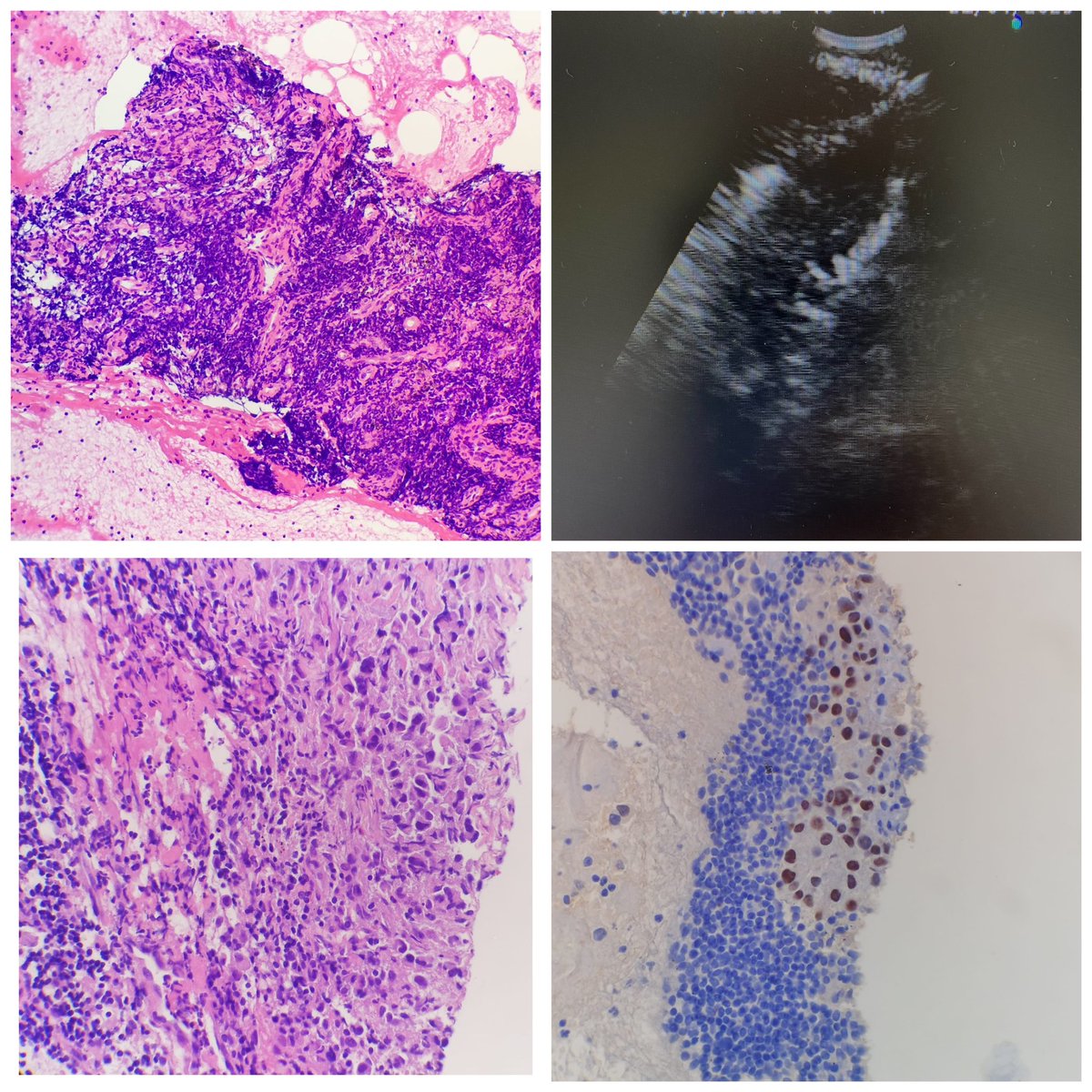 Paciente con Adenocarcinoma pulmonar previo, intervenido. 
Seguimiento: 11L sospechosa (TAC y PET). 
💉 EBUS negativo (imagen 1) se decide Crio-EBUS ❄️ 
🔬🦀 Adenocarcinoma (imagen 3, HE, 4, TTF1)
Gracias a nuestros grandes patólogos, qué fácil trabajar con ellos💪 <a href="/remimazorts/">Remi Mazorra</a>