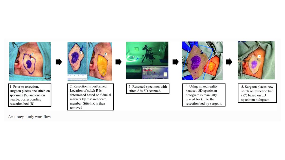 Cadaveric study by @_KavitaPrasad @Alexis_B_Miller @Kayvon_Sharif @Juan_Colazo @ye_wenda @EbenRosenthal & @TopfHNS demonstrated the feasibility & accuracy of augmented reality surgery to guide head and neck cancer re-resections. #HeadAndNeckCancer #AR link.springer.com/article/10.124…