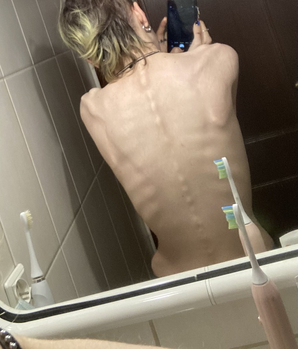 donttouchander's tweet photo. b0dychecks for edtwt🌟🌟
taken in the ed ward, i hate it here
⟳ always appreciated<3
# bonesp0 thinsp0 th1nspo bc legsspo legsp0 deathsp0 sicksp0 spine https://t.co/BpmN7lKN2V