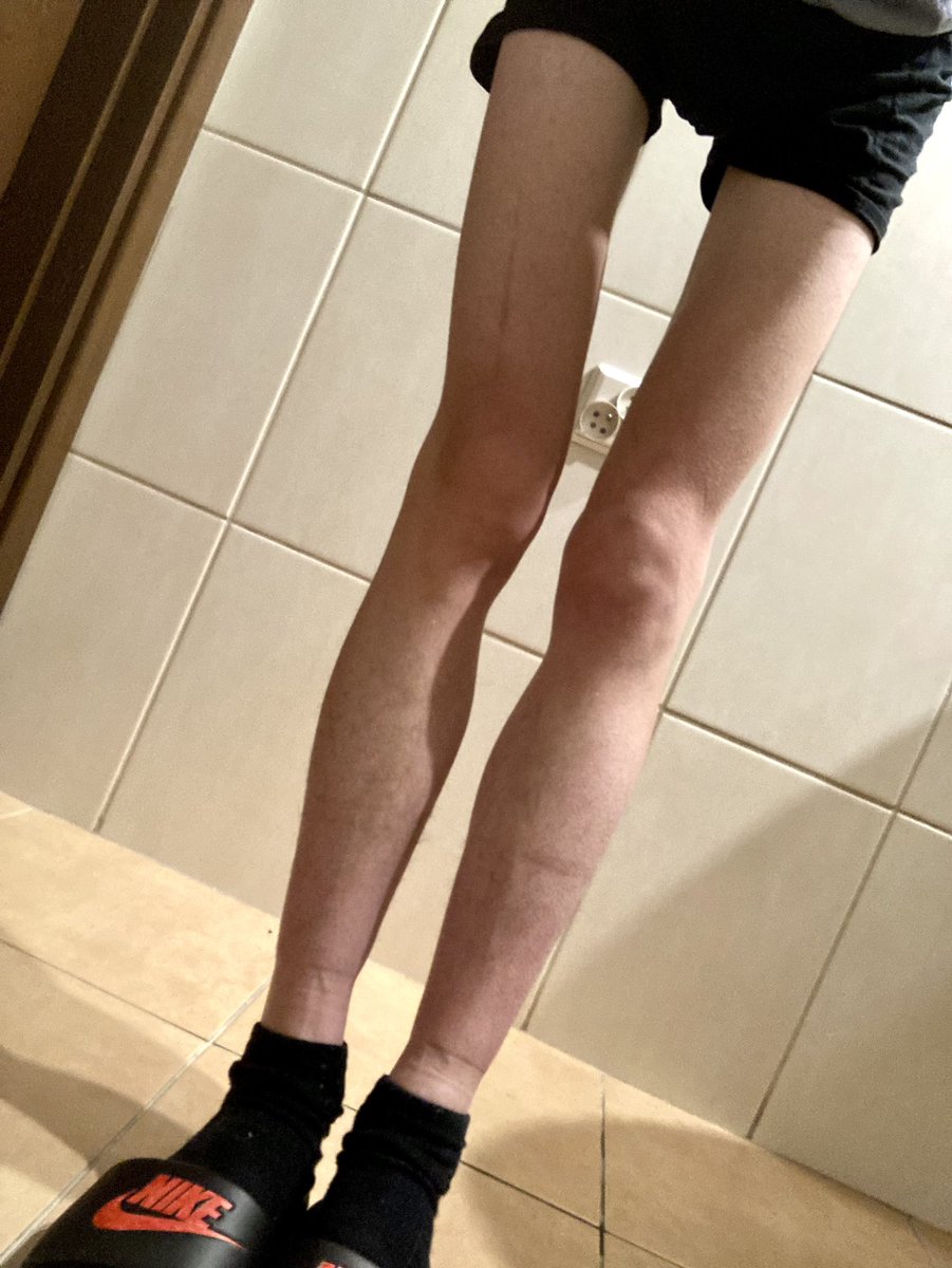 donttouchander's tweet photo. b0dychecks for edtwt🌟🌟
taken in the ed ward, i hate it here
⟳ always appreciated<3
# bonesp0 thinsp0 th1nspo bc legsspo legsp0 deathsp0 sicksp0 spine https://t.co/BpmN7lKN2V