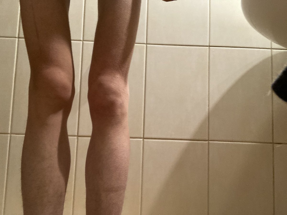 donttouchander's tweet photo. b0dychecks for edtwt🌟🌟
taken in the ed ward, i hate it here
⟳ always appreciated<3
# bonesp0 thinsp0 th1nspo bc legsspo legsp0 deathsp0 sicksp0 spine https://t.co/BpmN7lKN2V