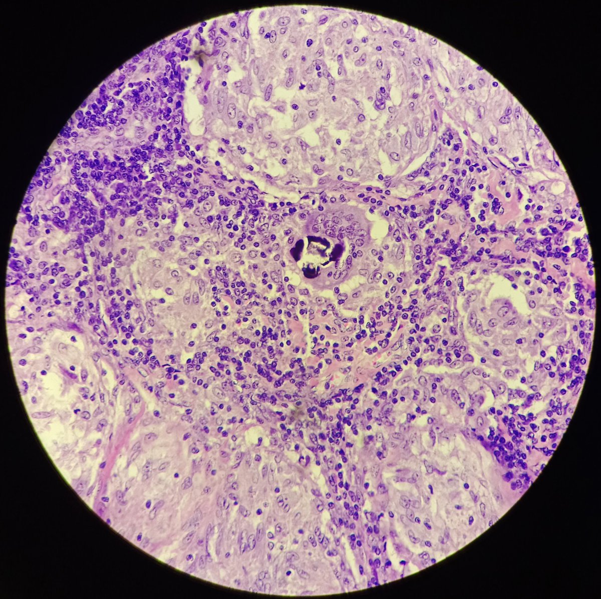 SyedSal55391459's tweet photo. #histopath
#granuloma
#schaumann body
Photomicrographs.
Inguinal lymph node.
Dx: Sarcoidosis. https://t.co/pfiDChjh7g