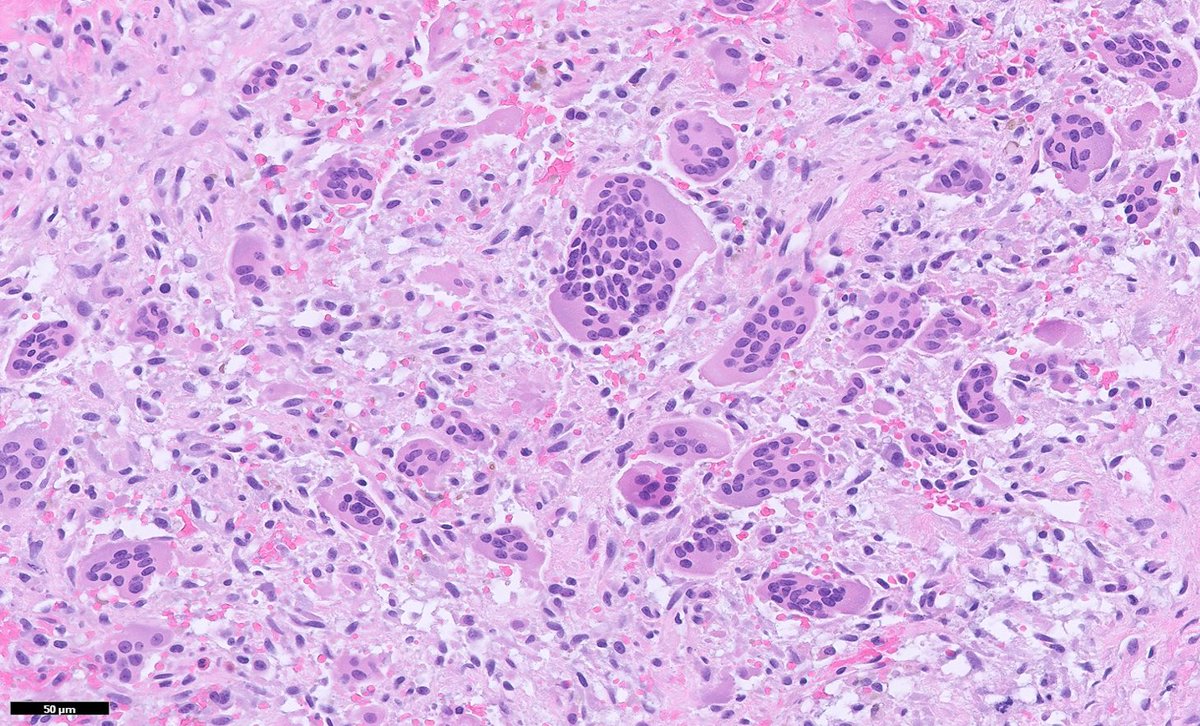 jme_walker's tweet photo. This came from a vertebral body, causing back pain. Any guesses for the diagnosis and what it may be a sign of clinically? #neuropath #PathTwitter #endocrine https://t.co/aIOcgOsqA7