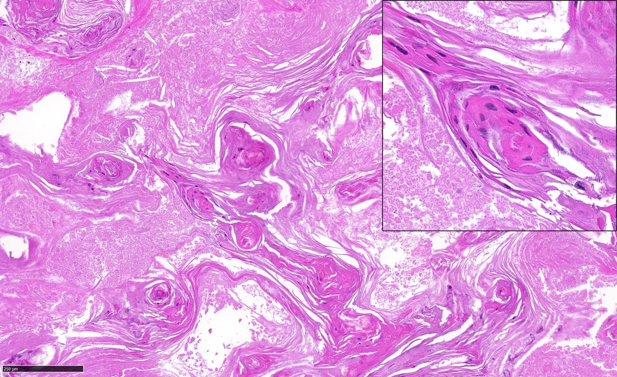 Typical histological feature in a metastatic #HNSCC lymph node following radiochemotherapy. #pathology #entpath