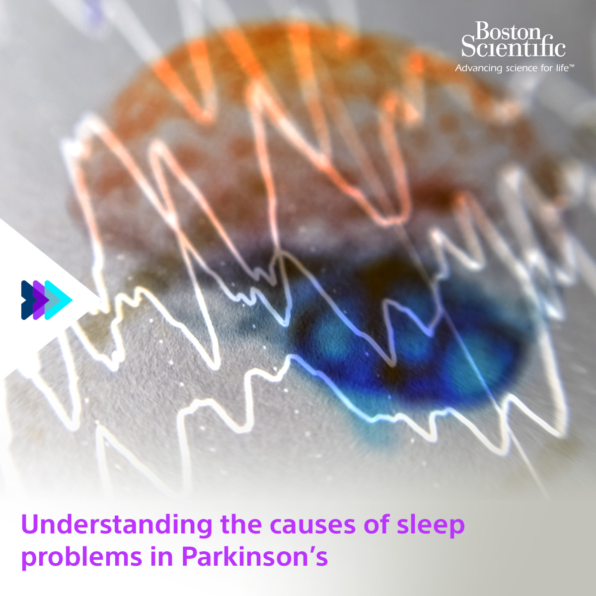 This #BetterSleepMonth we are drawing attention to the potential for #deepbrainstimulation (DBS) to improve sleep. Learn about Boston Scientific’s DBS options at bit.ly/41sU2KI
#DBS #parkinsons #essentialtremor