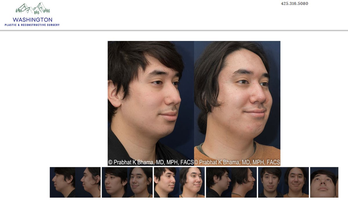 Rhinoplasty in Seattle WA – Our clinic and doctor sees patients noses from Bellevue, Everett, Mill Creek, Lynnwood, Seattle, WA and surrounding areas. For issues or concerns with size, nostrils, injury, discomfort, c... washingtonplasticsurg.com/nose-surgery-s…