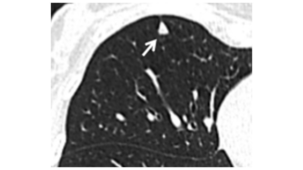 #ThoracicThursday!  What would you recommend for this 8 mm solitary #pulmonarynodule incidentally found in a low-risk patient?  #radiology #PCCM