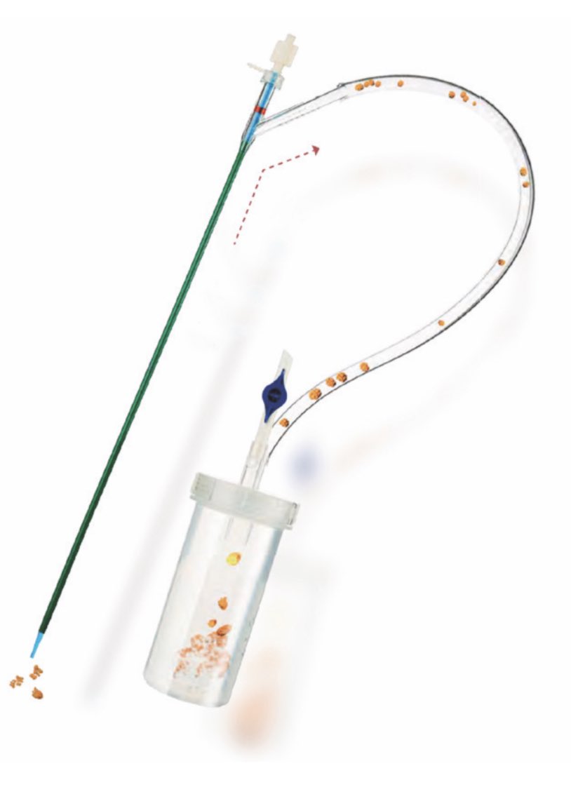 RaffaeleInzillo's tweet photo. Yesterday we tried the Brand-New #ClearPetra vacuum assisted Ureteral access sheath with a flexible tip. This new device allows to allways mantain a low intrarenal pressure and to easilly evacuate stone fragments from the renal calyx in which the stone is locaded @magicmilo85 https://t.co/uIG3K1HLoD