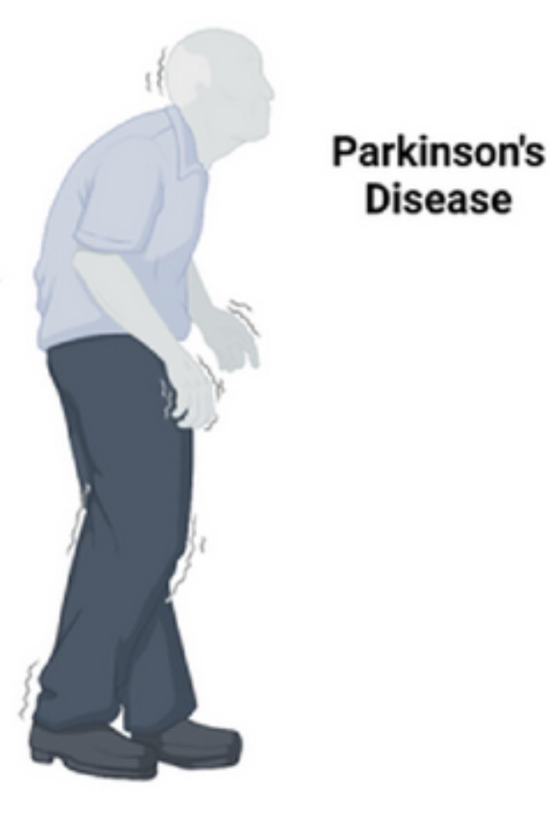 Hey authors, editors, and reviewers of #Parkinsons manuscripts… can we please stop using this drawing of a “person with Parkinson’s”? Time to move on from this 🙏please.