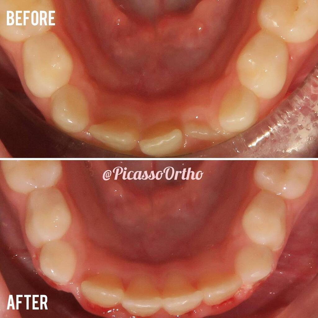 picassoortho's tweet photo. Phase 1 before &amp; after 😊
•

•

•
#picasso #picassoortho #orthodontist #orthodontics #dentist #dental #health #healthcare #healthy #doctor #doctors #happy #love #patient #smile #teeth #teethwhitening #braces #invisalign #awesome #cool #fun #instagood #instadaily #igdaily … https://t.co/zrtO7MoFrL