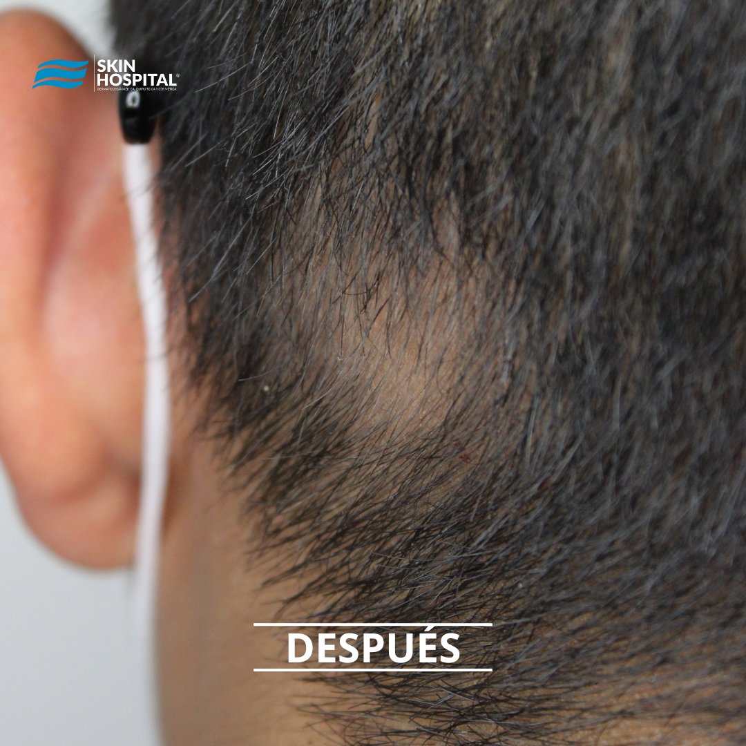 SkinHospital_mx's tweet photo. #ALOPECIAAREATA
Es un trastorno #autoinmune en el cual aparecen uno o mas parches redondos sin pelo.
Afecta a hombres y mujeres de cualquier edad.
El mejor tratamiento son los esteroides

-LOOK GOOD &amp; FEEL GOOD- https://t.co/9993nOs8Nb