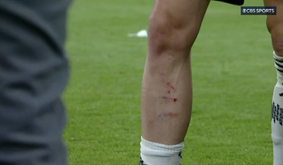 Juve_France's tweet photo. La jambe d’Adrien Rabiot après le coup qu’il a reçu sur cette action… https://t.co/1Pja0kTrBa