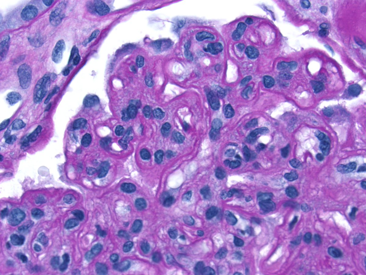 Nice example of chronic active antibody-mediated rejection with transplant glomerulopathy (and severe arteriolar hyalinosis from years of CNI use). Plenty of double contours and glomerulitis! #RenalPath
