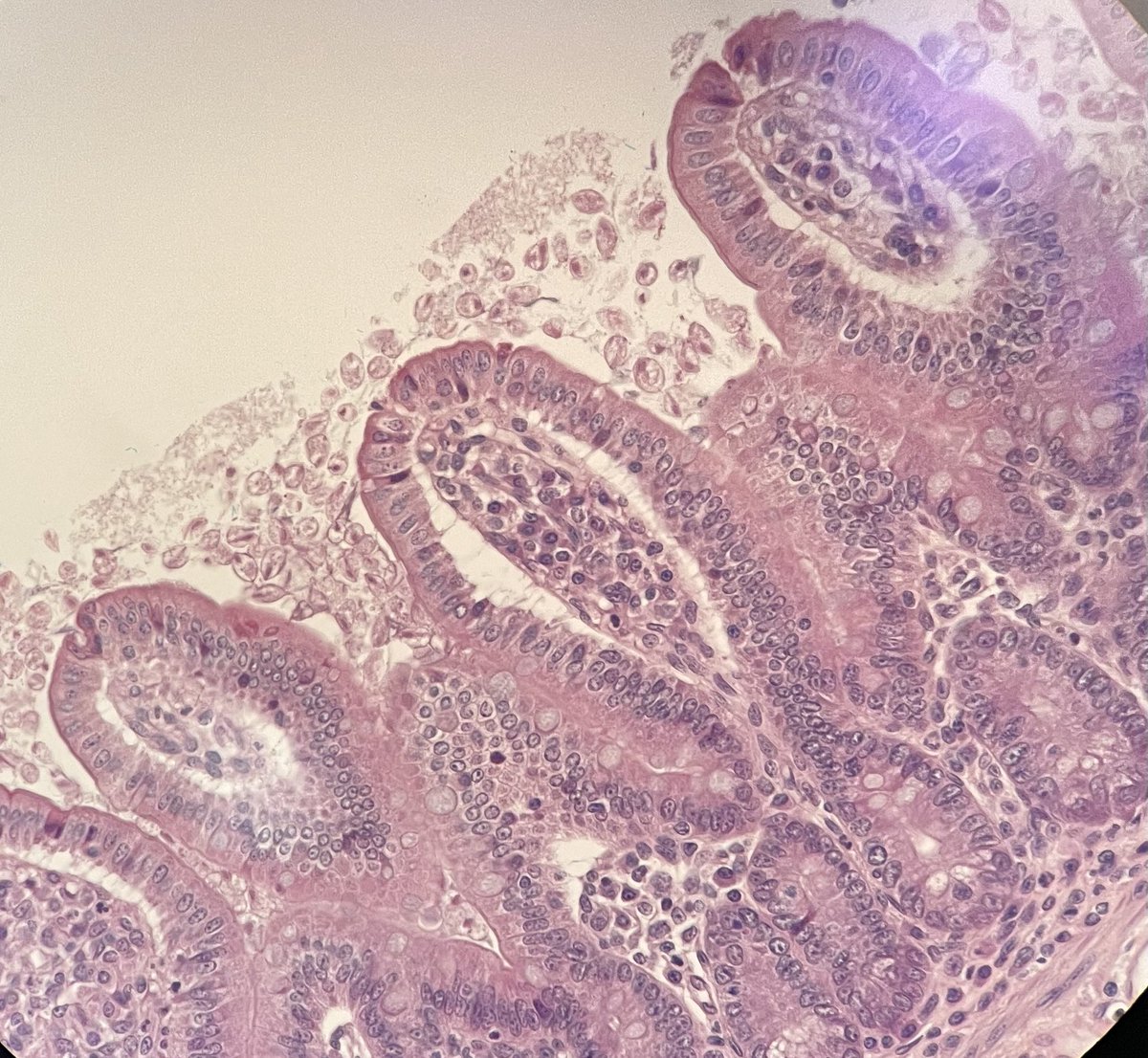 PRASENJIT DAS (@prasenj13259721) on Twitter photo Those accustomed with mouse model studies, may identify this not so uncommon infestation in mouse intestine. Any guess? <a href="/Pathoutlines/">PathologyOutlines.com</a> <a href="/pathologistmag/">The Pathologist</a> <a href="/AusGIPath/">AGPS</a> <a href="/PATHtweets/">PATH</a> Those accustomed with mouse model studies, may identify this not so uncommon infestation in mouse intestine. Any guess? <a href="/Pathoutlines/">PathologyOutlines.com</a> <a href="/pathologistmag/">The Pathologist</a> <a href="/AusGIPath/">AGPS</a> <a href="/PATHtweets/">PATH</a>