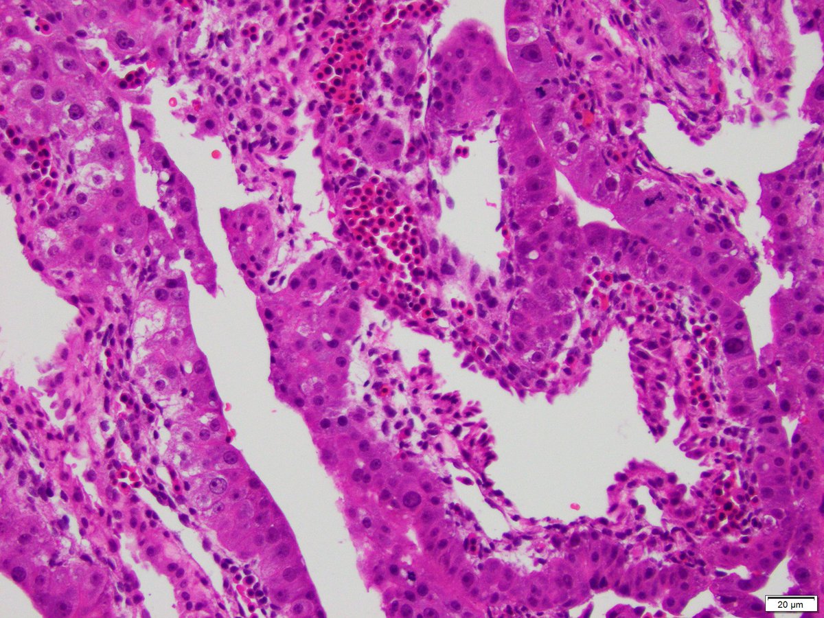 Leon Metlay (@leon_metlay) on Twitter photo Incidental finding in an ectopic pregnancy resected at 6 weeks. What is it? 4x, 10x, & 20x
<a href="/FscPathKMJ/">Kyla Jorgenson</a> and Ben Gertsen were there when I took the pictures, so they should let others have a chance.
#Pedipath #Pathtwitter #Path2Path #Embryo #MedStudentTwitter Incidental finding in an ectopic pregnancy resected at 6 weeks. What is it? 4x, 10x, & 20x
<a href="/FscPathKMJ/">Kyla Jorgenson</a> and Ben Gertsen were there when I took the pictures, so they should let others have a chance.
#Pedipath #Pathtwitter #Path2Path #Embryo #MedStudentTwitter