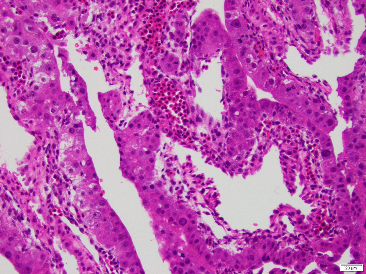 Incidental finding in an ectopic pregnancy resected at 6 weeks. What is it? 4x, 10x, & 20x @FscPathKMJ and Ben Gertsen were there when I took the pictures, so they should let others have a chance. #Pedipath #Pathtwitter #Path2Path #Embryo #MedStudentTwitter