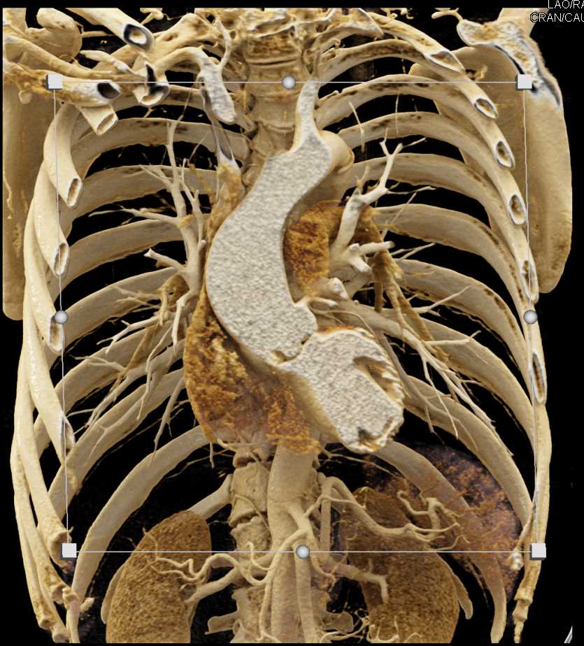 Dilated Aortic Root: ctisus.com/teachingfiles/…