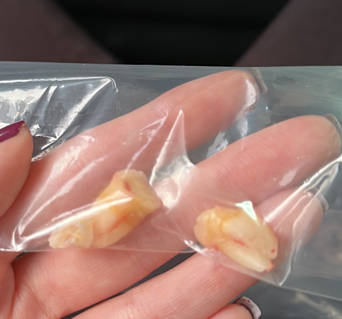 DanielaRuano_'s tweet photo. Como pode dois dentes me fazerem sofrer tanto? Um foi desgastado e o outro quebrado a coroa pra conseguir tirar https://t.co/WoPoJnGkV7