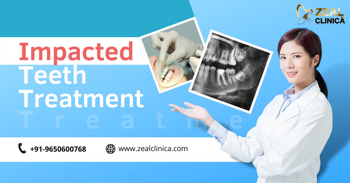 ZealClinica's tweet photo. Say goodbye 👋 to the discomfort caused by #ImpactedTeeth 🦷 with Zeal Clinica's expert treatment! Our team of skilled professionals 👨‍⚕️ offers a range of solutions to alleviate pain and restore your smile. 😁

#impactedtooth #tooth #wisdomtooth #wisdomteeth #oralsurgery #oralcare https://t.co/3y1zwvdP0D