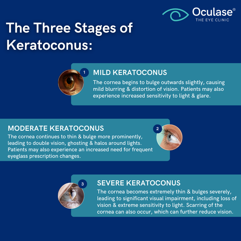 oculase's tweet image. 👨‍⚕ Keratoconus is a progressive eye disease that occurs when the cornea thins and starts bulging into a cone-like shape.

Learn more about the keratoconus treatment at Oculase: ⬇️
oculase.com/treatments/ker…

#Oculase #EyeDoctor #EyeCondition #Keratoconus #KeratoconusTreatment