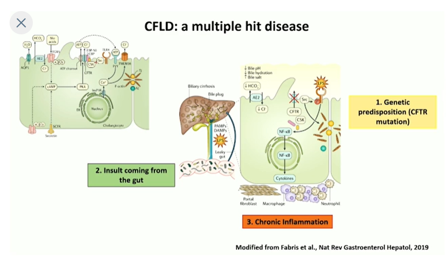 EASLedu's tweet photo. Challenging the current view of the cyctic fibrosis related liver disease #EASLMono
👉Moving from the secretory defect hypothesis to a gut-liver hypothesis
@EASLNews
#LiverTwitter #CFLD https://t.co/IPGwEIR3AW