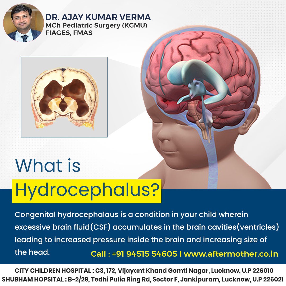 DrAjayKumarVer6's tweet photo. #PosteriorUrethral #Urethralvalve #kidsproblem #childworm #babycare #childcancer #pediatricurologists #lucknow
.
Dr. Ajay Verma
Consultant Neonatal and Pediatric Surgeon MBBS,MS,MCh.Pediatric Surgery(KGMU,Lucknow) FIAGES,FMAS
https://t.co/4FqaGwAqa1 https://t.co/iEBWU4vVyX