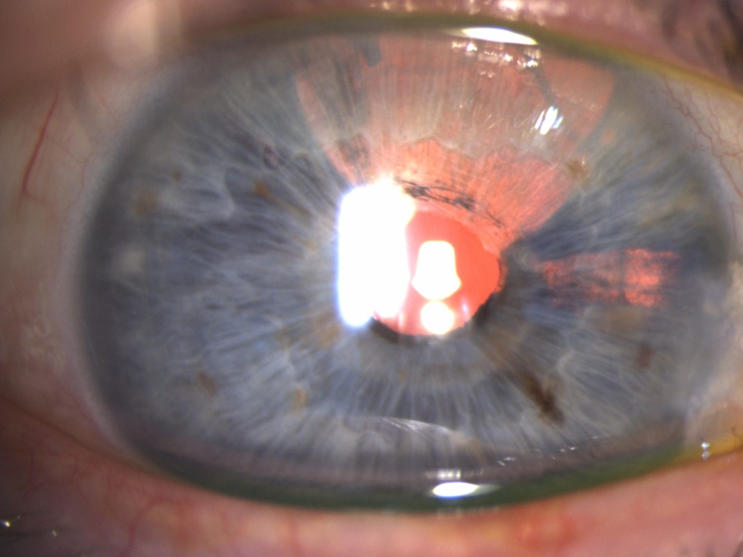 Defect In The Iris Iris Transillumination Defects Pseudoexfoliation Syndrome: A Hidden