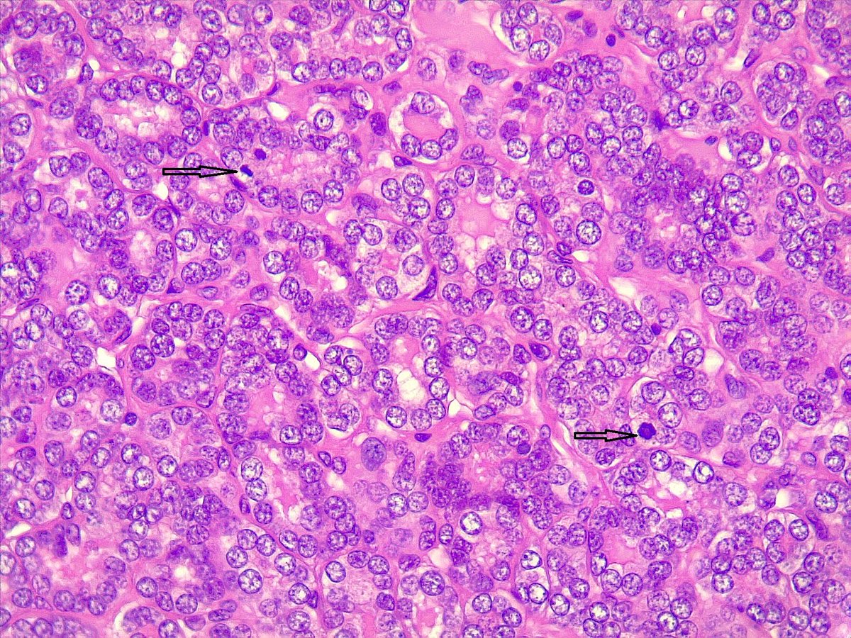 ariabdullah1978's tweet photo. 19 F, thyroid nodule, 1.6cm, FNA was Bethesda IV, suspicious for follicular neoplasm, lobectomy followed, have capsular invasion, single vascular invasion, mitosis  12/2 mm²
How would you sing it out? https://t.co/qQbg1I7eIw
