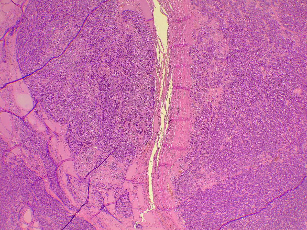 ariabdullah1978's tweet photo. 19 F, thyroid nodule, 1.6cm, FNA was Bethesda IV, suspicious for follicular neoplasm, lobectomy followed, have capsular invasion, single vascular invasion, mitosis  12/2 mm²
How would you sing it out? https://t.co/qQbg1I7eIw