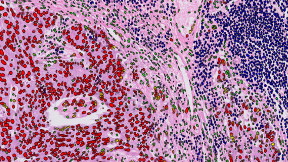 We're thrilled to announce the opening of the ICR/<a href="/royalmarsdenNHS/">The Royal Marsden NHS Foundation Trust</a>' Integrated #Pathology Unit!

This first-of-its-kind unit in England aims to improve #Cancer diagnosis and treatment by combining pioneering digital imaging with #AI 👇
icr.ac.uk/news-archive/e…