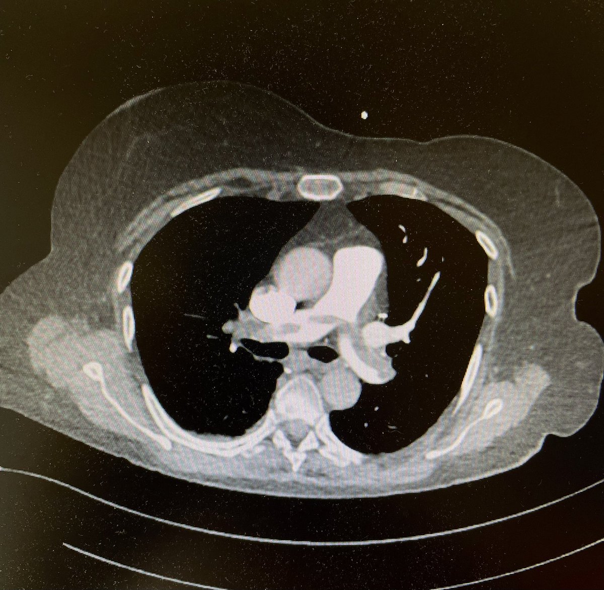 Daniel Messiha, MD (@realdocdan) on Twitter photo Very high-risk central bilat #PE (PESI 135) in 76 yo pt. Happy to have been part of interv. thrombectomy <a href="/InariMedical/">Inari Medical</a> with <a href="/aljanosi/">Alexander Jánosi</a> & <a href="/alrashidfadi/">Fadi Al-Rashid</a> this week. Impressive yield w/ immediate
⬇️ CVP from 20 to 11 mmHg
⬇️ sPAP from 45 to 30 mmHg
⬇️ oxygen demand
#CardioTwitter Very high-risk central bilat #PE (PESI 135) in 76 yo pt. Happy to have been part of interv. thrombectomy <a href="/InariMedical/">Inari Medical</a> with <a href="/aljanosi/">Alexander Jánosi</a> & <a href="/alrashidfadi/">Fadi Al-Rashid</a> this week. Impressive yield w/ immediate
⬇️ CVP from 20 to 11 mmHg
⬇️ sPAP from 45 to 30 mmHg
⬇️ oxygen demand
#CardioTwitter