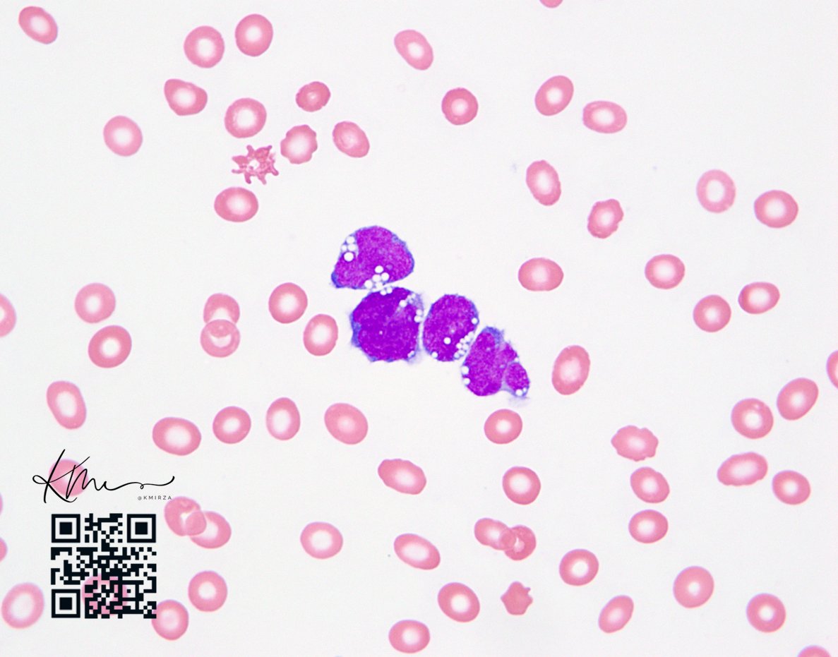 Friendly reminder that not all blastoid cells with vacuolated basophilic cytoplasm (cytology) are Burkitt. Case in point is this blastoid variant of mantle cell lymphoma in a pericardial effusion #lymsm #hemepath #lymphoma - remember that high grade B cell lymphomas and