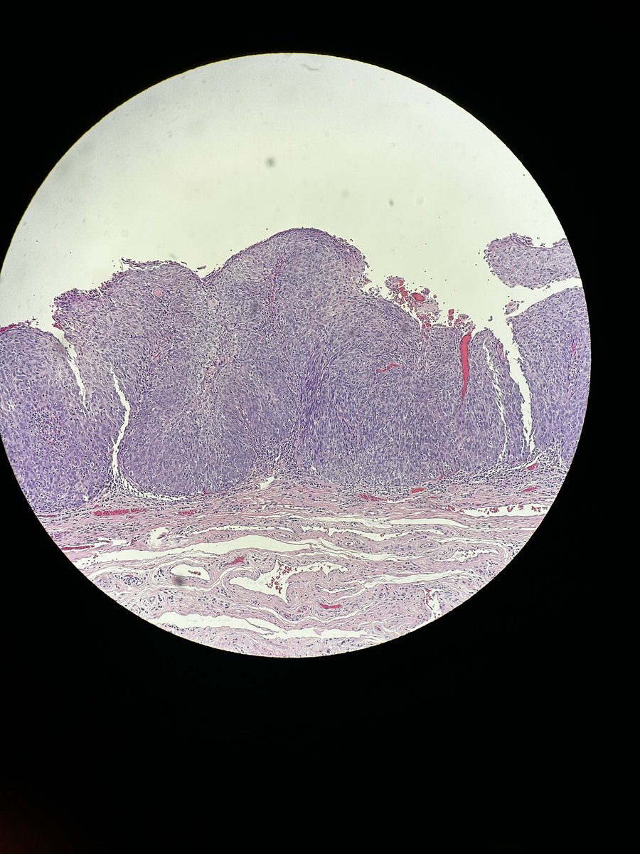 Path4People's tweet photo. Good news? Itโs Friday! ๐๐ฝ๐ค
๐ข itโs also #casestudyfriday ๐ง๐ฉบ Hereโs a 63 year old smoker with 1.7 cm rare lesion on penis. Learn about it below!๐ #path4people
https://t.co/CSv7H2A2gT
(gross photo is not from actual case) https://t.co/XizlV0ui1Q