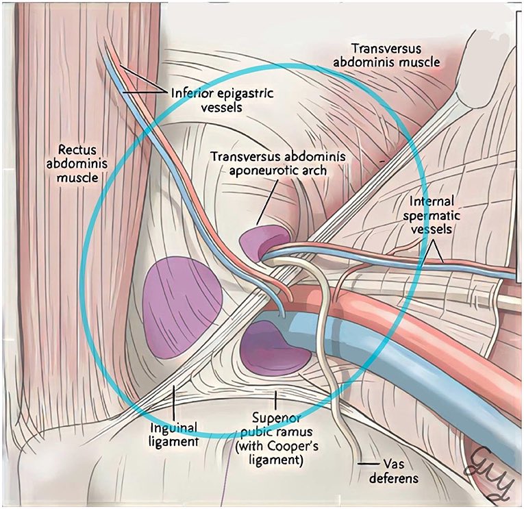 CiruAndes2's tweet photo. Surgical approaches for groin hernia 🚵🏻🪢🗣️💡Summary in one image📌⤵️✅! #SoMe4Surgery @pferrada1 @juliomayol @SWexner @PipeCabreraV @herniasrosario @RicardoRGlz @ericpaulimd @LiangRhea https://t.co/QsXh0g6SSf