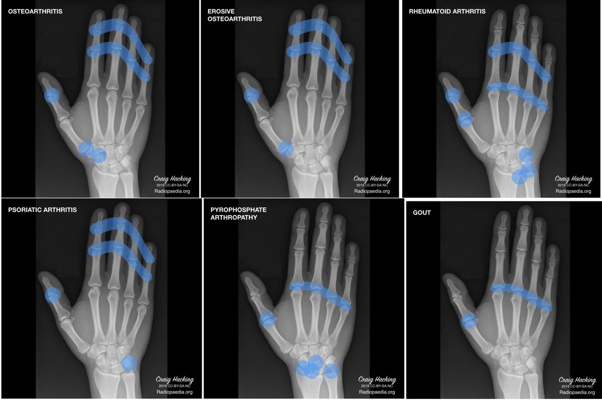 Hand arthropathies distribution for MSK noobs like me.

Hacking C, Hand arthropathies - distribution  (diagram). Case study, Radiopaedia.org (Accessed on 12 May 2023)  doi.org/10.53347/rID-6…
