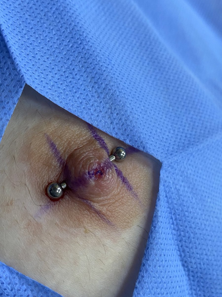 ABpiercer's tweet photo. Bruna me procurou pq queria furar o mamilitcho porém não tinha biquinho (era invertido).
Era né, pq agora não é mais.
Pra quem não sabe, é possível perfurar mamilo invertido sim
só que precisamos analisar o caso antes viu😉
#piercingnomamilo #mamilo #mamiloinvertido #piercingrj https://t.co/7jqcgV7vvv