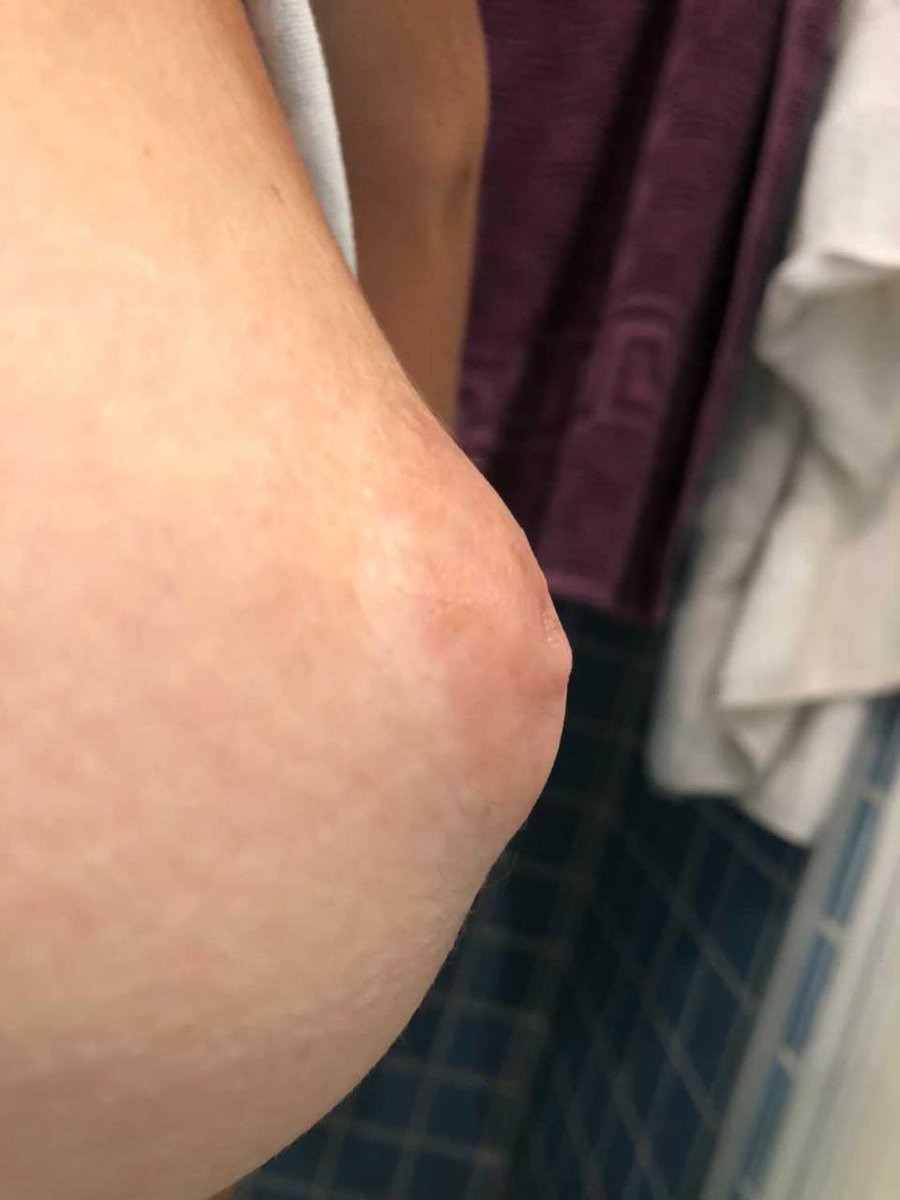 ABpiercer's tweet photo. Bruna me procurou pq queria furar o mamilitcho porém não tinha biquinho (era invertido).
Era né, pq agora não é mais.
Pra quem não sabe, é possível perfurar mamilo invertido sim
só que precisamos analisar o caso antes viu😉
#piercingnomamilo #mamilo #mamiloinvertido #piercingrj https://t.co/7jqcgV7vvv