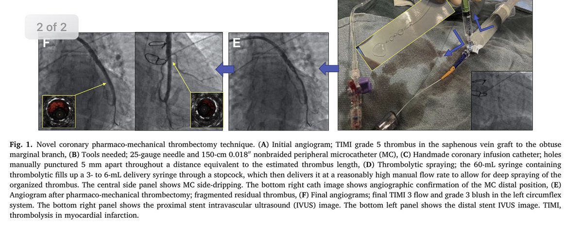 Hady Lichaa, MD, FACC, FSCAI, FSVM, RPVI (@hadylichaamd) on Twitter photo <a href="/HakimIcu/">Hakim Noman ,MD,PHD,FHRS,FSCAI</a> <a href="/RadialFirstBot/">RadialFirstBot</a> <a href="/BotPci/">PCICaseBot</a> <a href="/mirvatalasnag/">MIЯVΛƬ #IC</a> <a href="/AlkashkariWail/">Wail AlkashkariFSCAI,FPICSوائل القشقرى🇸🇦🇨🇦🇺🇲</a> <a href="/shody1402/">Shady Rashed شادي راشد</a> <a href="/mornei2011/">Neisser M</a> <a href="/evandrofilhobr/">Evandro Martins F. MD</a> <a href="/MGtberg/">Matthias Götberg</a> <a href="/alaa_gabi/">ALAA GABI 🇵🇸 🇺🇸</a> <a href="/ANazmiCalik/">A.Nazmi Calik</a> <a href="/Izanagi_no_mi_/">Izanagi No Mikoto</a> <a href="/KPujdak/">Dr. Krzysztof Pujdak</a> #CoronaryPMT #PharmacoMechanicalThrombectomy technique would be helpful.Published in <a href="/MyJSCAI/">MyJSCAI</a>
jscai.org/article/S2772-…
<a href="/BagaiJayant/">Jay Bagai</a> <a href="/mobitz/">BJefferson</a> <a href="/VladLakhter/">Vladimir Lakhter</a> <a href="/brownc_12/">Christopher Brown</a> <a href="/TheNarulaSeries/">Arvin Narula</a> <a href="/adityadoc1/">Aditya Bharadwaj</a> <a href="/AbdullahAlabcha/">Abdullah Al-Abcha</a> <a href="/MatthiesenTimm/">Timm Matthiesen 📯</a> <a href="/MohammedQintar/">Mohammed Qintar, MD MSc</a> <a href="/kaschenke/">Karsten Schenke 📯 @kaschenke.blsky.social</a> <a href="/piccoloraf/">Raffaele Piccolo</a> #Cardiotwitter <a href="/HakimIcu/">Hakim Noman ,MD,PHD,FHRS,FSCAI</a> <a href="/RadialFirstBot/">RadialFirstBot</a> <a href="/BotPci/">PCICaseBot</a> <a href="/mirvatalasnag/">MIЯVΛƬ #IC</a> <a href="/AlkashkariWail/">Wail AlkashkariFSCAI,FPICSوائل القشقرى🇸🇦🇨🇦🇺🇲</a> <a href="/shody1402/">Shady Rashed شادي راشد</a> <a href="/mornei2011/">Neisser M</a> <a href="/evandrofilhobr/">Evandro Martins F. MD</a> <a href="/MGtberg/">Matthias Götberg</a> <a href="/alaa_gabi/">ALAA GABI 🇵🇸 🇺🇸</a> <a href="/ANazmiCalik/">A.Nazmi Calik</a> <a href="/Izanagi_no_mi_/">Izanagi No Mikoto</a> <a href="/KPujdak/">Dr. Krzysztof Pujdak</a> #CoronaryPMT #PharmacoMechanicalThrombectomy technique would be helpful.Published in <a href="/MyJSCAI/">MyJSCAI</a>
jscai.org/article/S2772-…
<a href="/BagaiJayant/">Jay Bagai</a> <a href="/mobitz/">BJefferson</a> <a href="/VladLakhter/">Vladimir Lakhter</a> <a href="/brownc_12/">Christopher Brown</a> <a href="/TheNarulaSeries/">Arvin Narula</a> <a href="/adityadoc1/">Aditya Bharadwaj</a> <a href="/AbdullahAlabcha/">Abdullah Al-Abcha</a> <a href="/MatthiesenTimm/">Timm Matthiesen 📯</a> <a href="/MohammedQintar/">Mohammed Qintar, MD MSc</a> <a href="/kaschenke/">Karsten Schenke 📯 @kaschenke.blsky.social</a> <a href="/piccoloraf/">Raffaele Piccolo</a> #Cardiotwitter