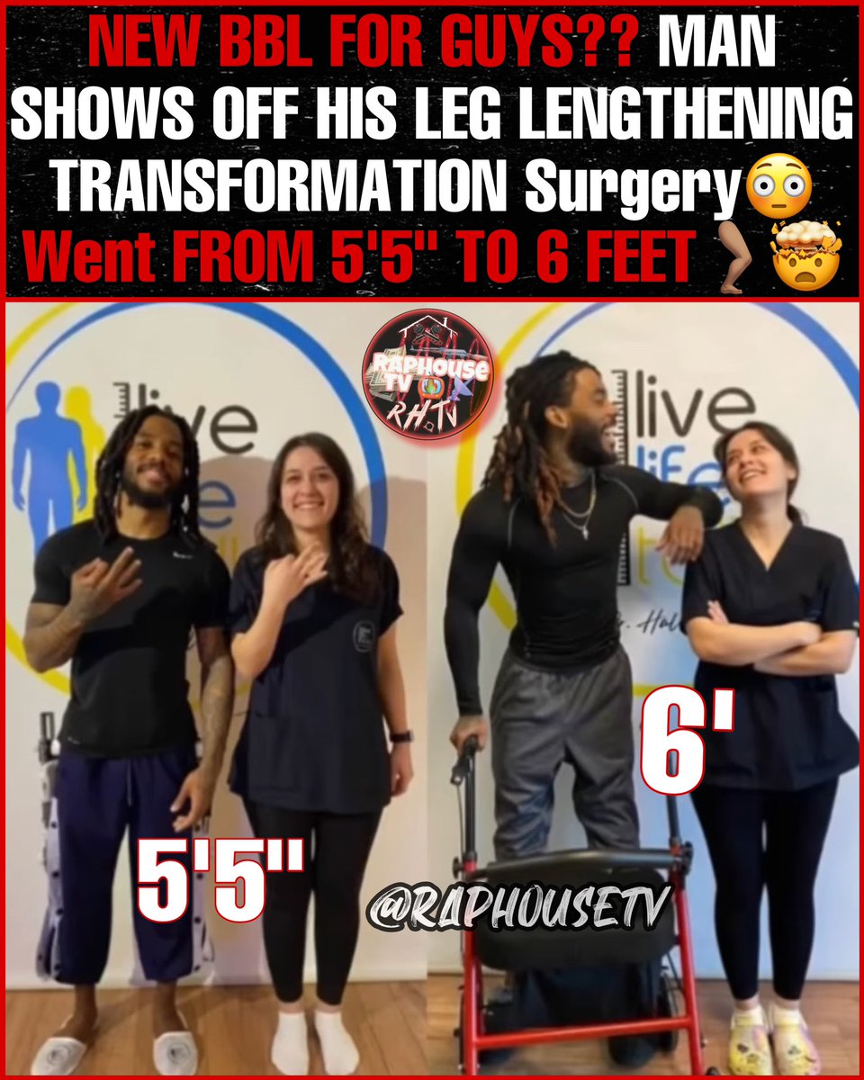 New BBL For Guys?? Man shows off his leg Transformation Surgery 😳 he Went from 5’5” to 6 Feet in height🦵🏽🤯