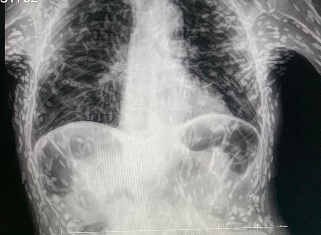 TMIHARINI's tweet photo. CW // disturbing content

Mengeluh sering batuk, X-Ray pasien menunjukkan parasit menyebar di sekujur tubuh

Parasit ini masuk karena mengonsumsi daging babi yg tidak dimasak dgn baik

Pasien sedang menunggu hasil MRI untuk mengetahui apakah parasitnya sudah masuk otak atau belum https://t.co/mM8aGQGQ6U