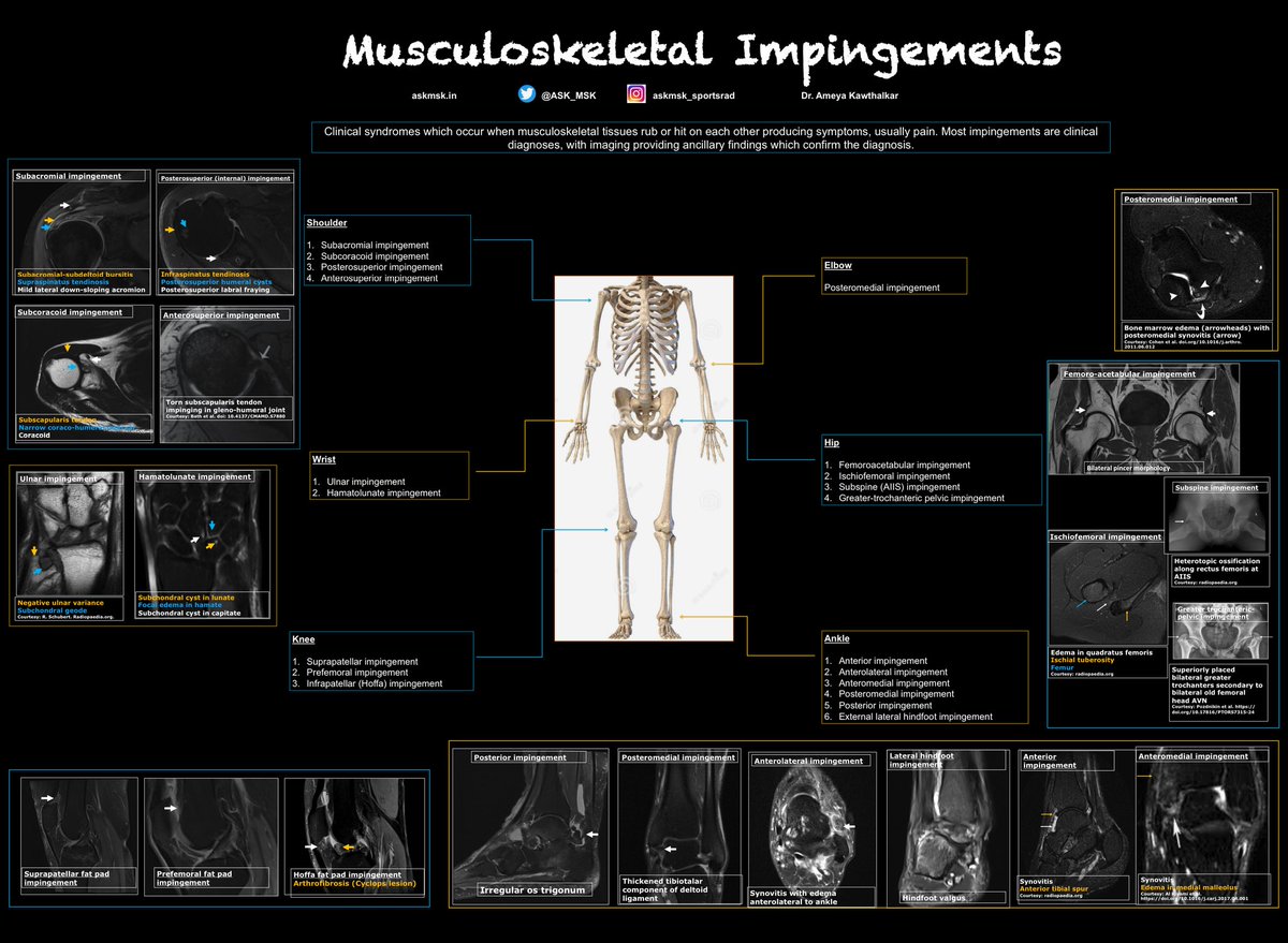 An overview of Musculoskeletal Impingements