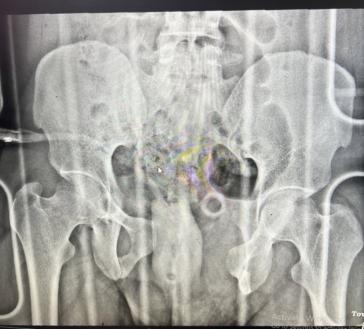 Bipin Theruvil FRCS (T&O),FRCS (Ed&Glasg),MS AIIMS tweet media