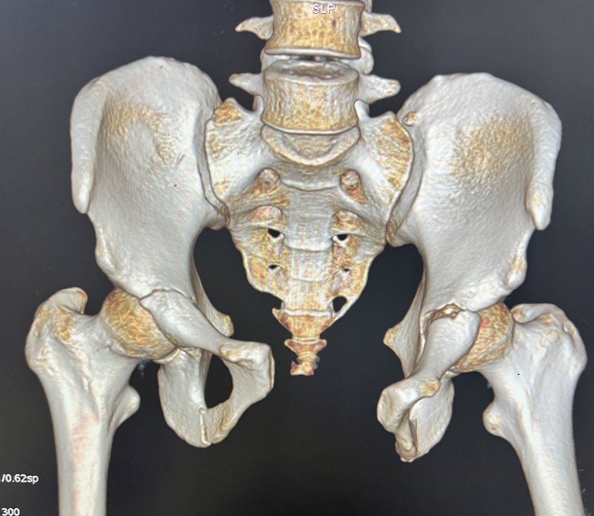 Bipin Theruvil FRCS (T&O),FRCS (Ed&Glasg),MS AIIMS tweet media