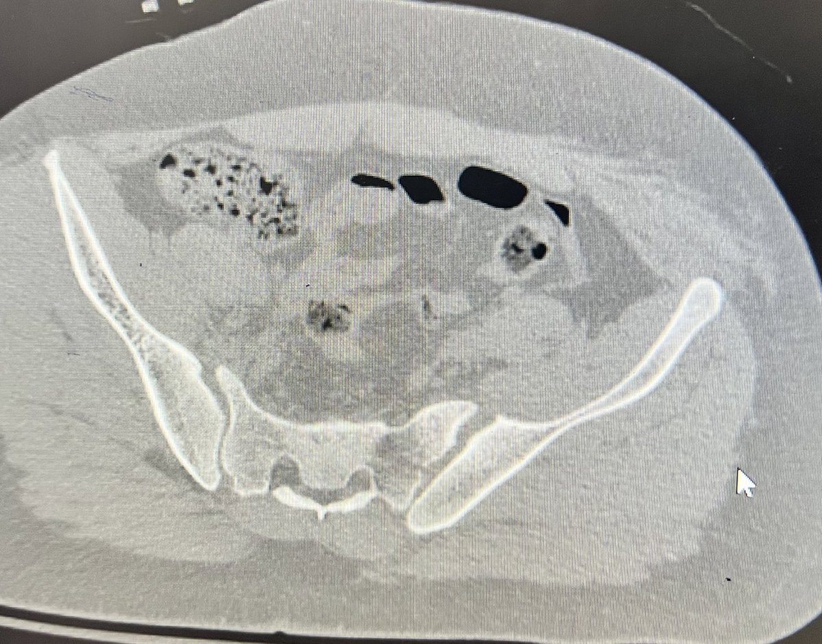 Bipin Theruvil FRCS (T&O),FRCS (Ed&Glasg),MS AIIMS tweet media