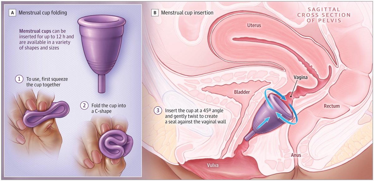 This JAMA Insights discusses the menstrual cup, a typically reusable, flexible, self-retaining intravaginal menstrual fluid collection device, and how it can reduce waste, simplify menstrual hygiene, and provide accessibility for resource-poor communities. ja.ma/3M9RKf4