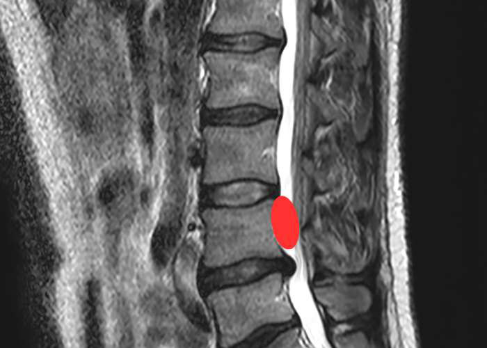 bpennicookeMD's tweet photo. How are #spinalcord #ependymomas diagnosed?

The images from an MRI or CT scan will allow Dr. Pennicooke to take a closer look &amp; determine the tumor’s size, location &amp; other important characteristics. He may also recommend a lumbar puncture is performed. https://t.co/3d5KXDnE2S https://t.co/UENlvQjQ5l