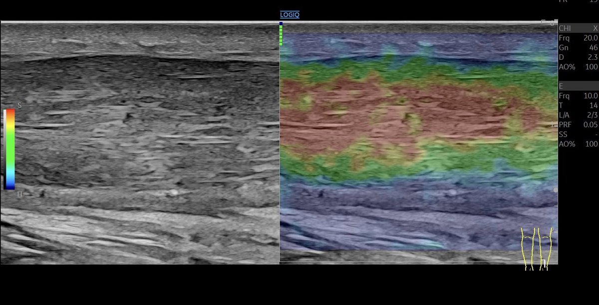 Tendinopathy of the #achillestendon Grade 4+ with nicely visible #neovascularization in B-Mode #mskus #oocus #pocushub #GElogiqE10r3 #tendinopathy