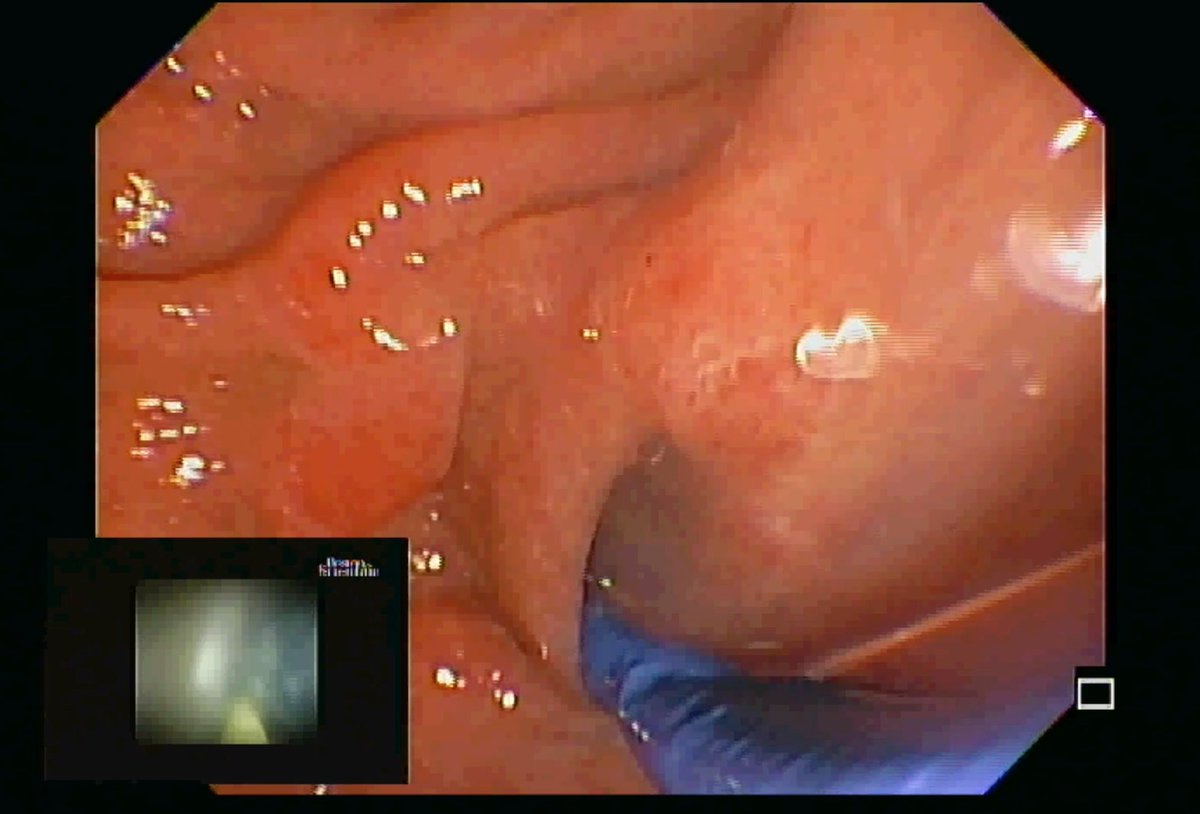 RJ Sealock (@rjsealock) on Twitter photo Appreciate the opportunity to contribute to Practical Gastroenterology's special series on the Fundamentals of ERCP. Check out our section on Pancreatoscopy. <a href="/EndoscopyOthman/">Mohamed Othman</a> <a href="/DouglasAdlerMD/">Douglas G. Adler MD, FASGE, FACG, AGAF</a>
practicalgastro.com/wp-content/upl… Appreciate the opportunity to contribute to Practical Gastroenterology's special series on the Fundamentals of ERCP. Check out our section on Pancreatoscopy. <a href="/EndoscopyOthman/">Mohamed Othman</a> <a href="/DouglasAdlerMD/">Douglas G. Adler MD, FASGE, FACG, AGAF</a>
practicalgastro.com/wp-content/upl…